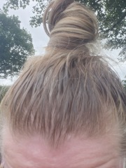 Anyone been brave enough to get botox on their scalp to stop sweating?