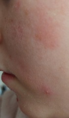 Spots on face and groin