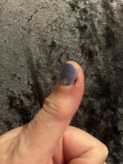 Is my thumb infected? Gross pic