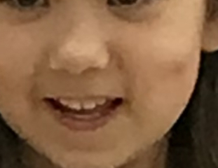 Dimple caused by cheek injury