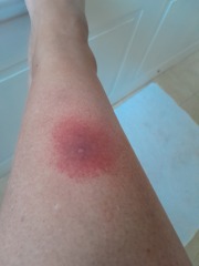 Insect bite- is this infected?