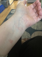 How to stop this rash
