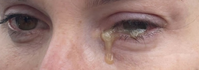 Conjunctivitis- does this look normal? Gross pic warning