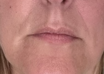 What is this strange face lumpiness and who do I see about it?