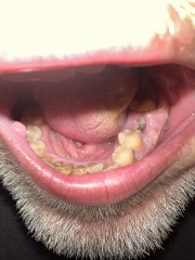 Does this look like a dry socket?