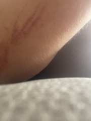 Burst blood vessels ? Pic included