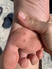 What’s this on my child’s foot??