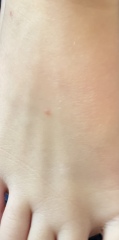 Molluscum Contagiosum?