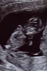12 week scan sex guesses