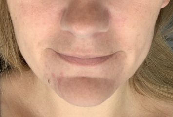 Perioral dermatitis - is it a perimenopause thing?! Has anyone got rid of it?