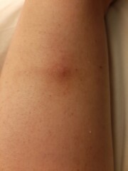 To ask if I should go to A&E or call 111? Pics included