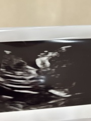 Pregnancy Scans