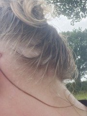 Anyone been brave enough to get botox on their scalp to stop sweating?