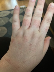 How to stop this rash