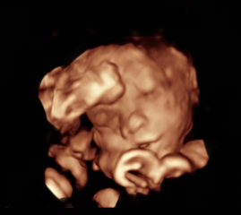 Ivf pregnancy - first trimester