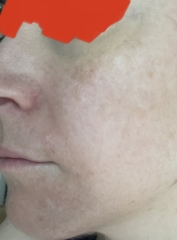 Can anyone help me get an even complexion??
