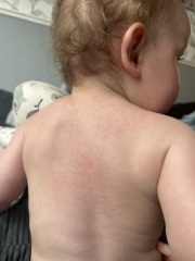 Help what's this rash?