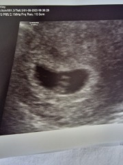 ID Twin early ultrasound advice