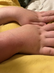 Dd bug bite (pic) antihistamines /ibuprofen anything else to help avoid antibiotics?