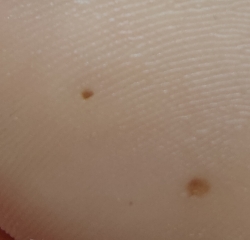 Are these verrucas?