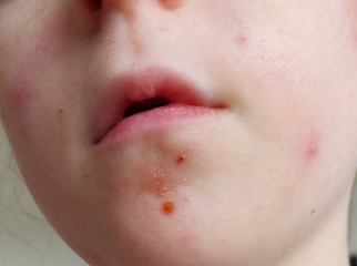 Spots on face and groin