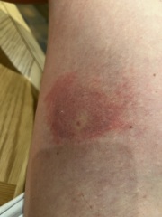Is this cellulitis?