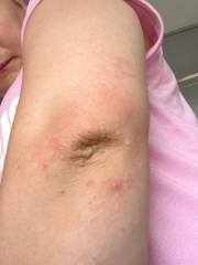 Rash… on elbows?!?!