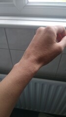 Wisdom tooth/gum infection - feel so unwell