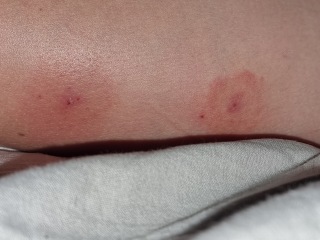 Do these mosquito bites need checking out?