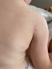 Spots/rash MMR reaction or chicken pox or something else?