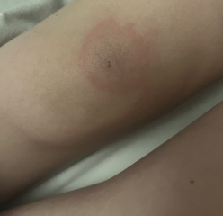 Lyme disease?