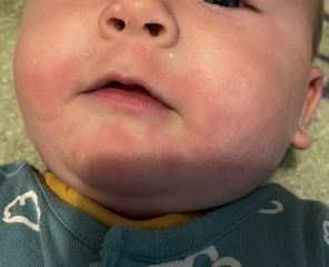 Rash on babies face after yoghurt/eggs