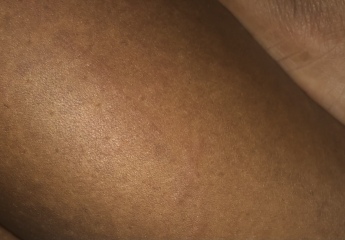 Chronic hives on boobs , PLS help .I’m miserable