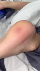 Verruca or something else?