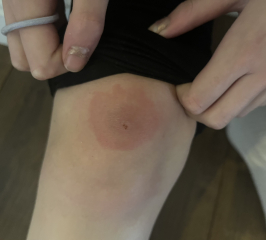 Lyme disease?