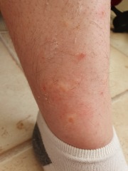 Bed bugs or fleas?
