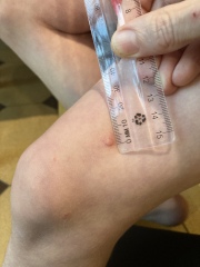 What’s this on my son’s leg?
