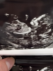 Pregnancy Scans