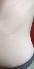 Chicken pox again?