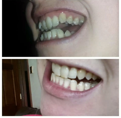 Adult braces