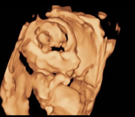 Ivf pregnancy - first trimester