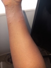 Rapidly expanding rash