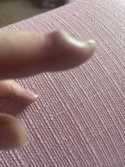 Infected cuticle