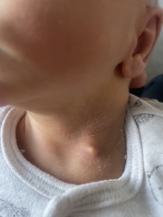 what's this spot on my baby (with pics)