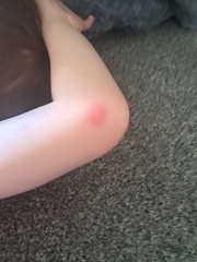 Bites or allergy?