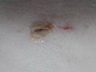 (sensitive pics of wound )surgical incision infected?