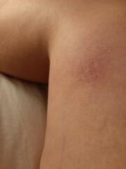 To ask if I should go to A&E or call 111? Pics included