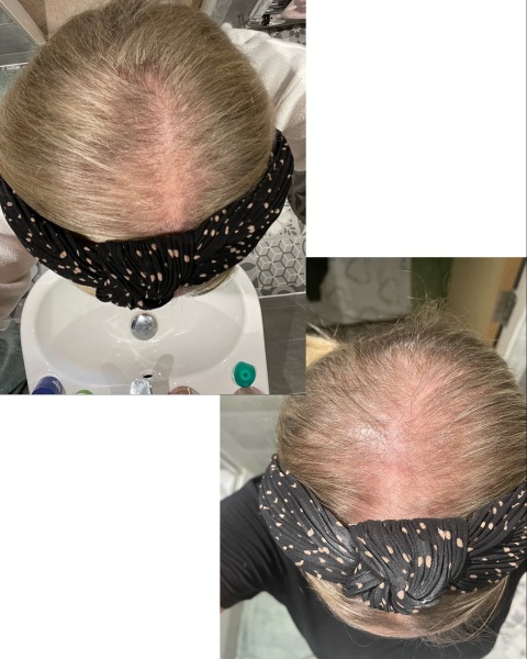 Hair Mesh System