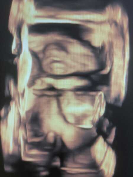 TIFFA scan