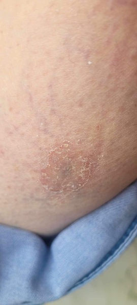Is this Bulls Eye ( Lyme disease)? Pictures added, any Dr here please?